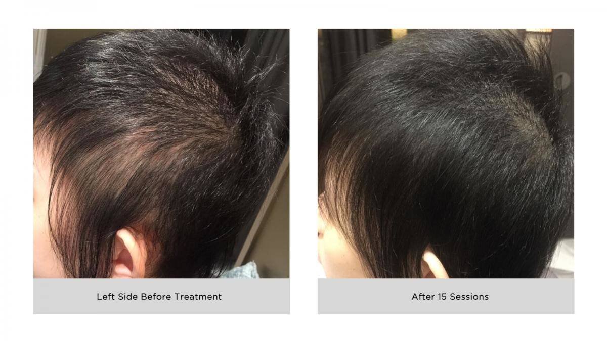 best hair loss treatment singapore before after