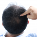 effective treatments male hair loss singapore